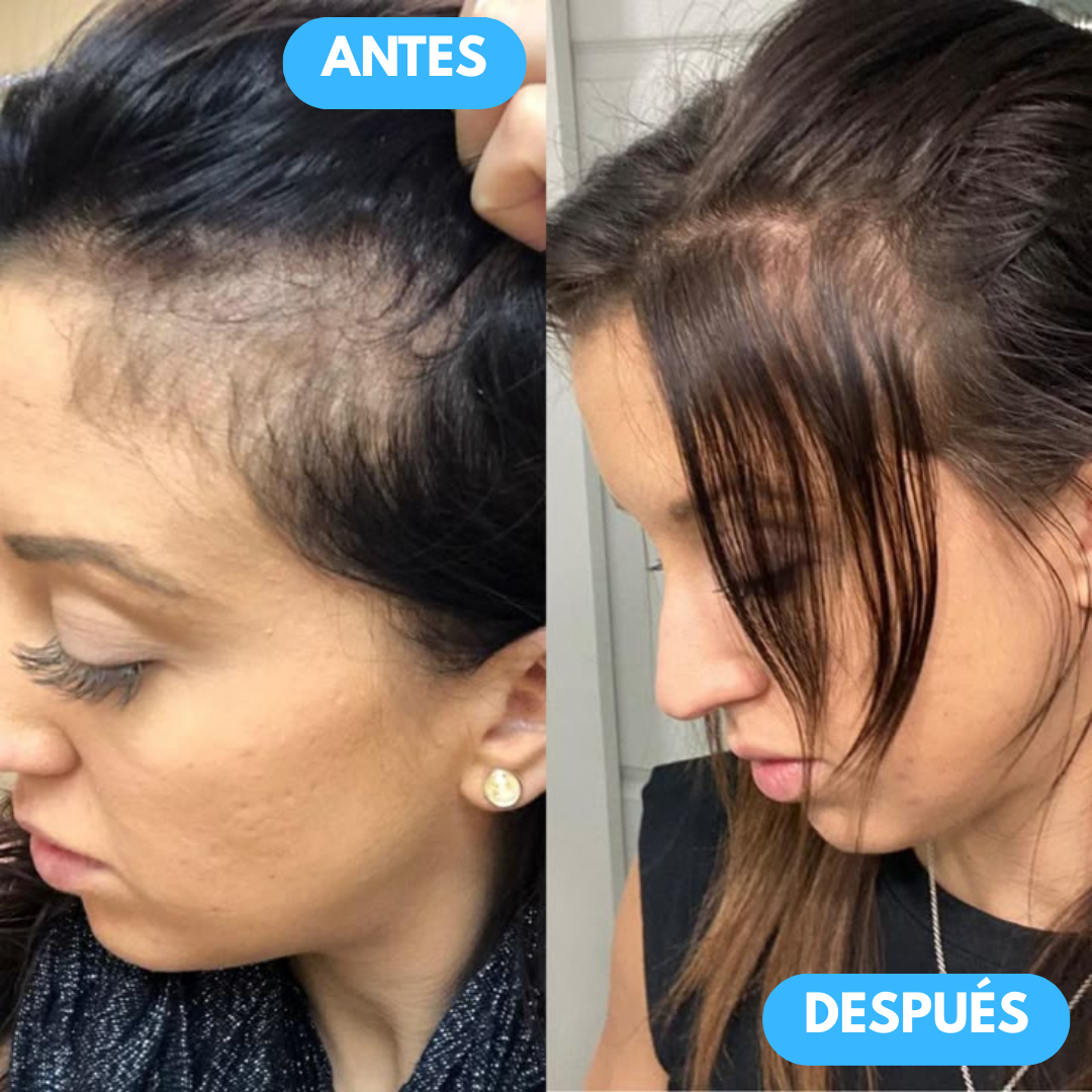 PACK ANIVERSARIO GRATIS | Champú AntiCaída Sovana - Refortalece tu cabello en 7 días