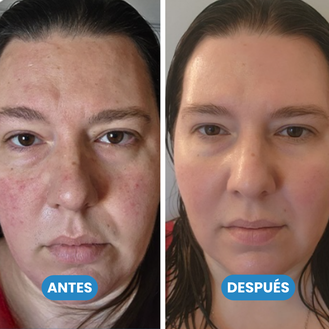 Sanorys Centella - Elimina manchas y puntos negros de tu rostro en sólo 6 días