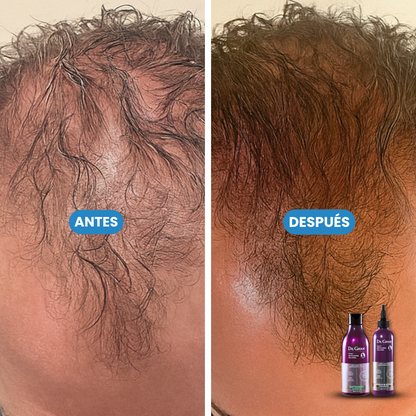 Sovana Dr. Groot- Champú coreano para la pérdida del cabello