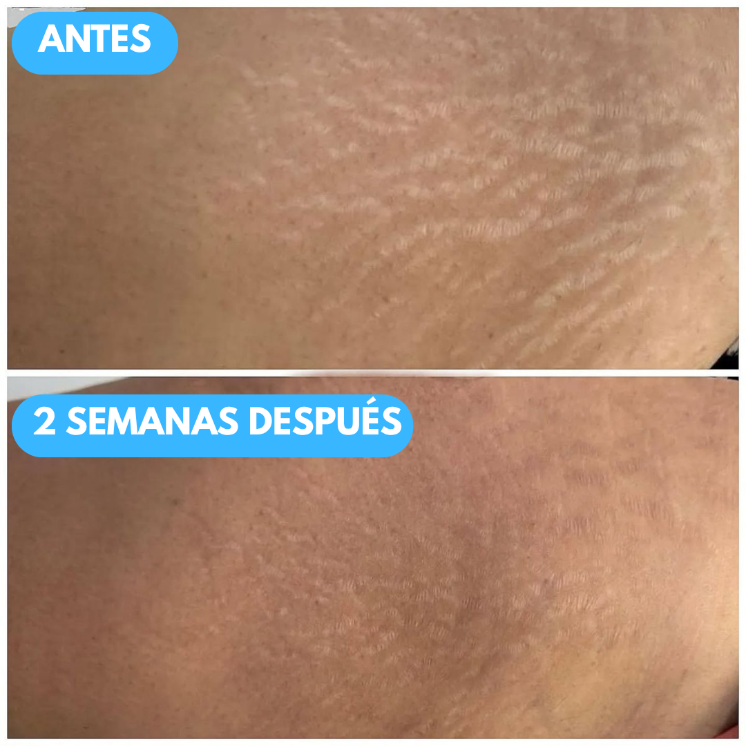 Sovana B Flat - Crema para el tratamiento de estrías