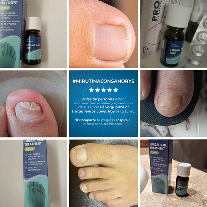 Sanorys Fung - Líquido para eliminar hongos de las uñas