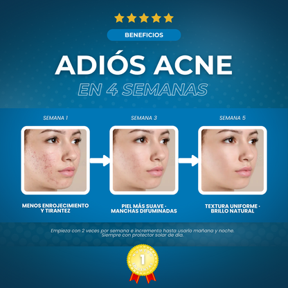 Sovana Anua - Sérum para eliminar tus manchas de acné en 6 días